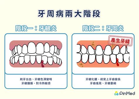 缺牙會漏財嗎|門牙縫變大擔心漏財又尷尬！一覽形成原因、3種解決。